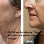 Does Morpheus8 Really Produce New Collagen